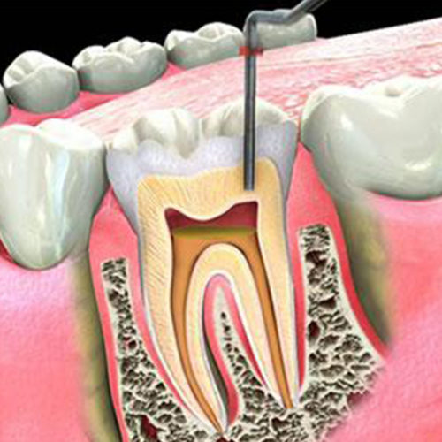 ENDODONTOLOGIE (WURZELBEHANDLUNG)